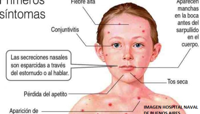 Alerta epidemiológica: caso confirmado de sarampión en la Ciudad